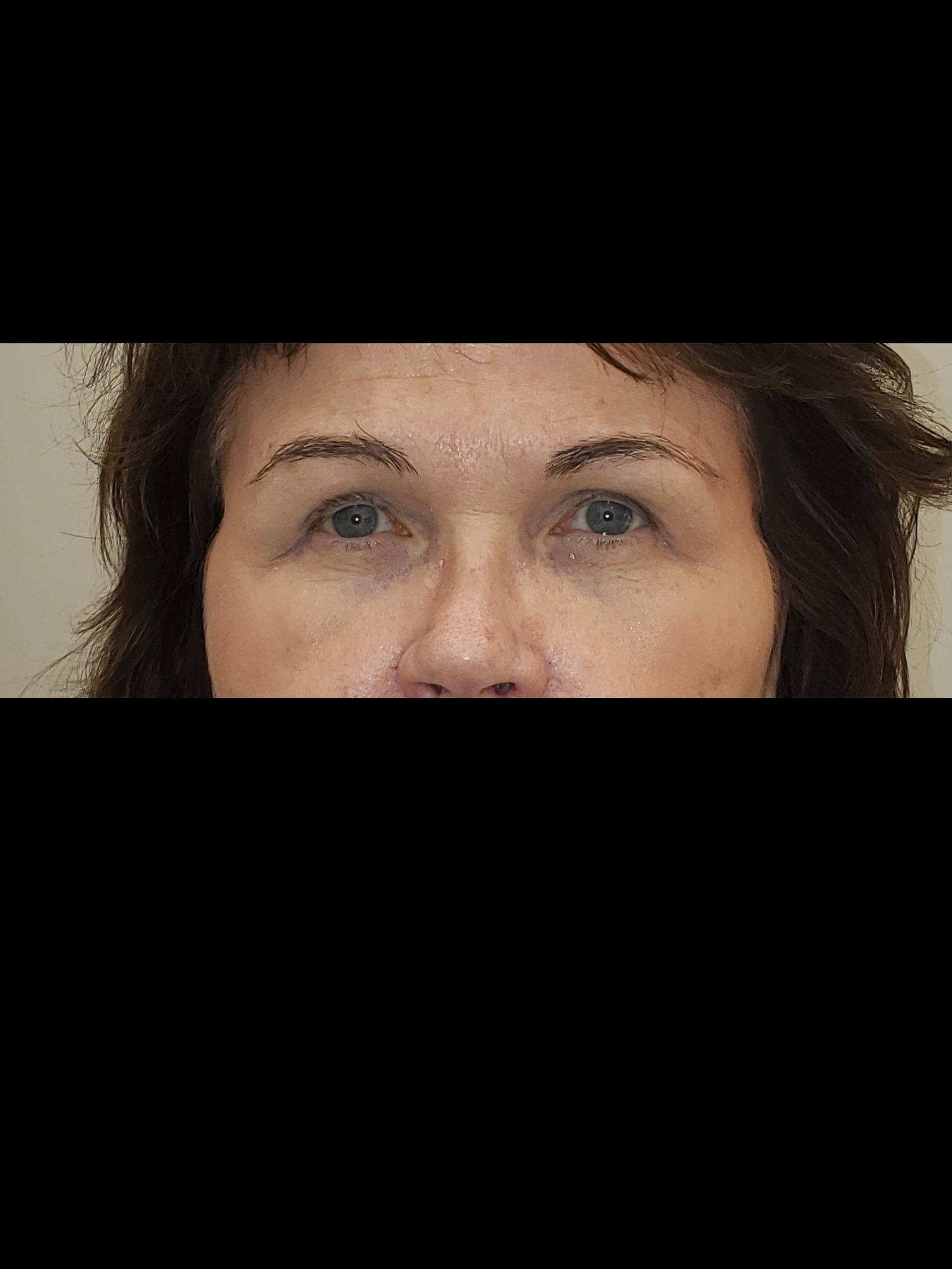 Brow Lift After