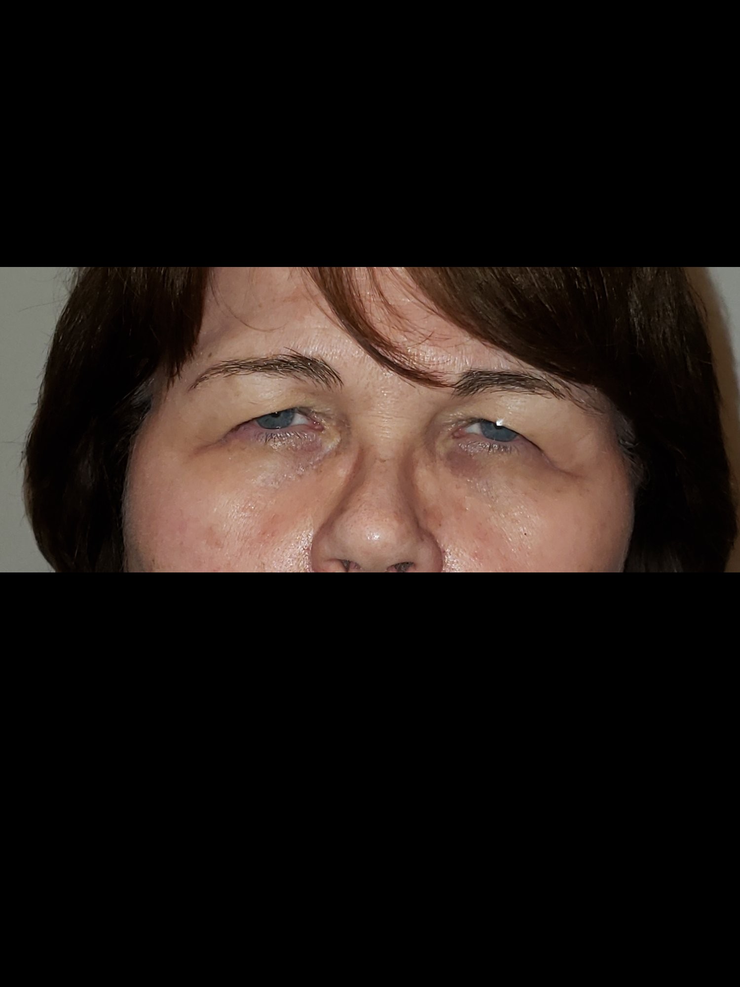 Brow Lift Before