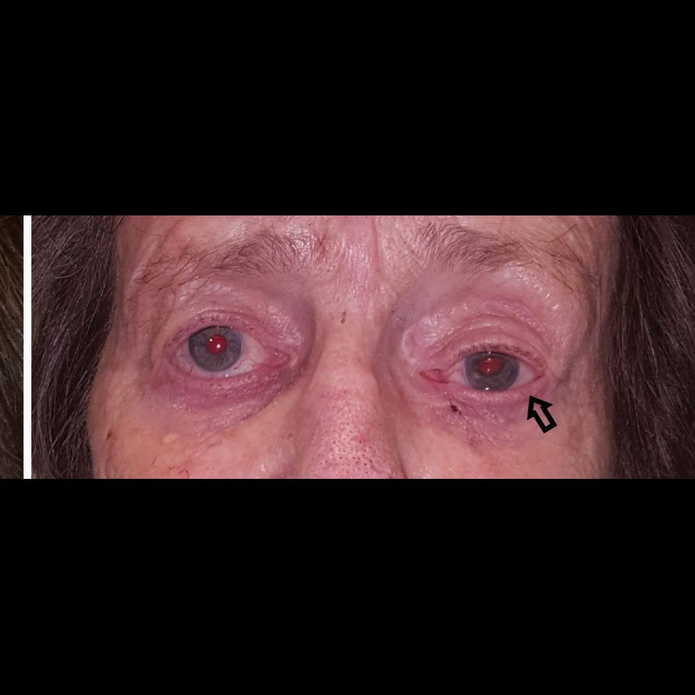 Ectropion Repair After