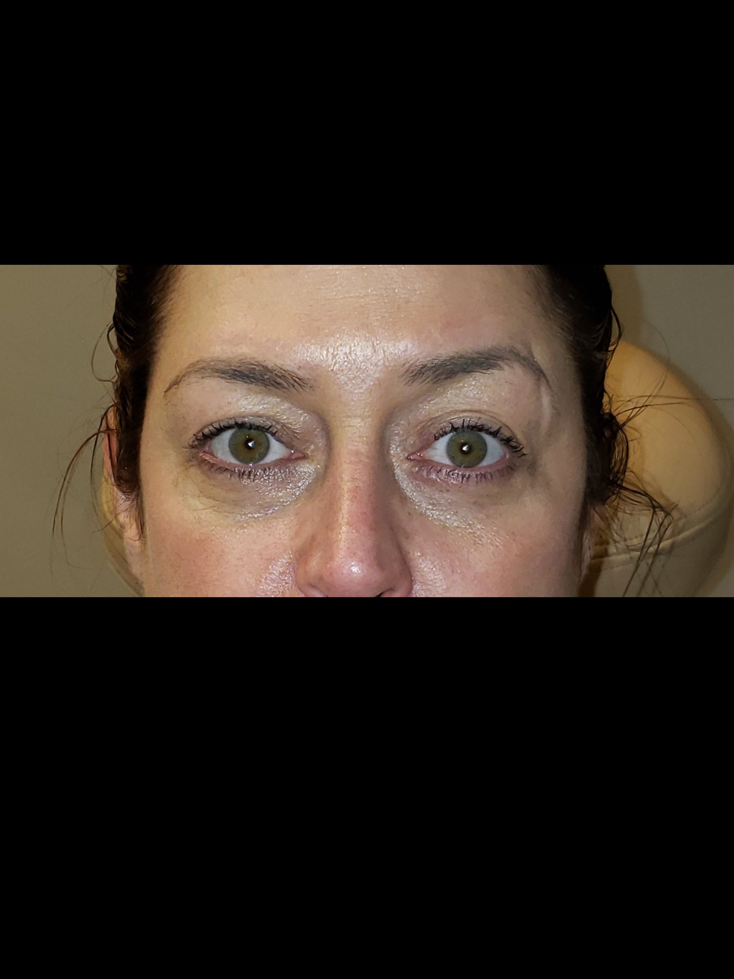 Complete Eyelid Rejuvenation After