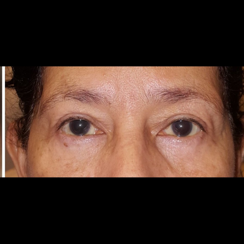 Complete Eyelid Rejuvenation After