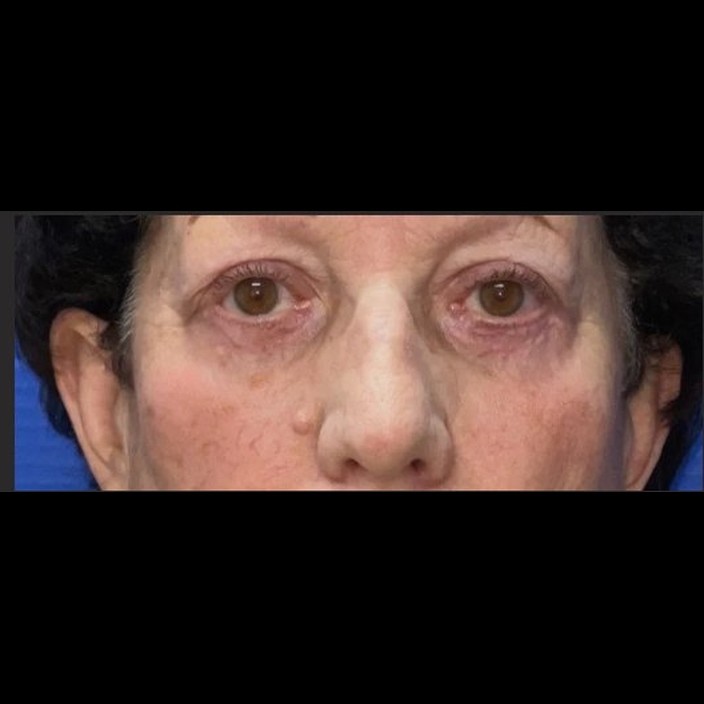 Complete Eyelid Rejuvenation After