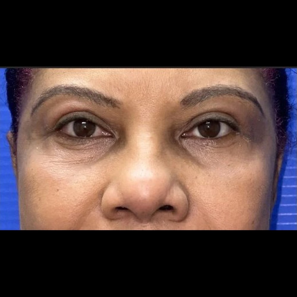Complete Eyelid Rejuvenation After