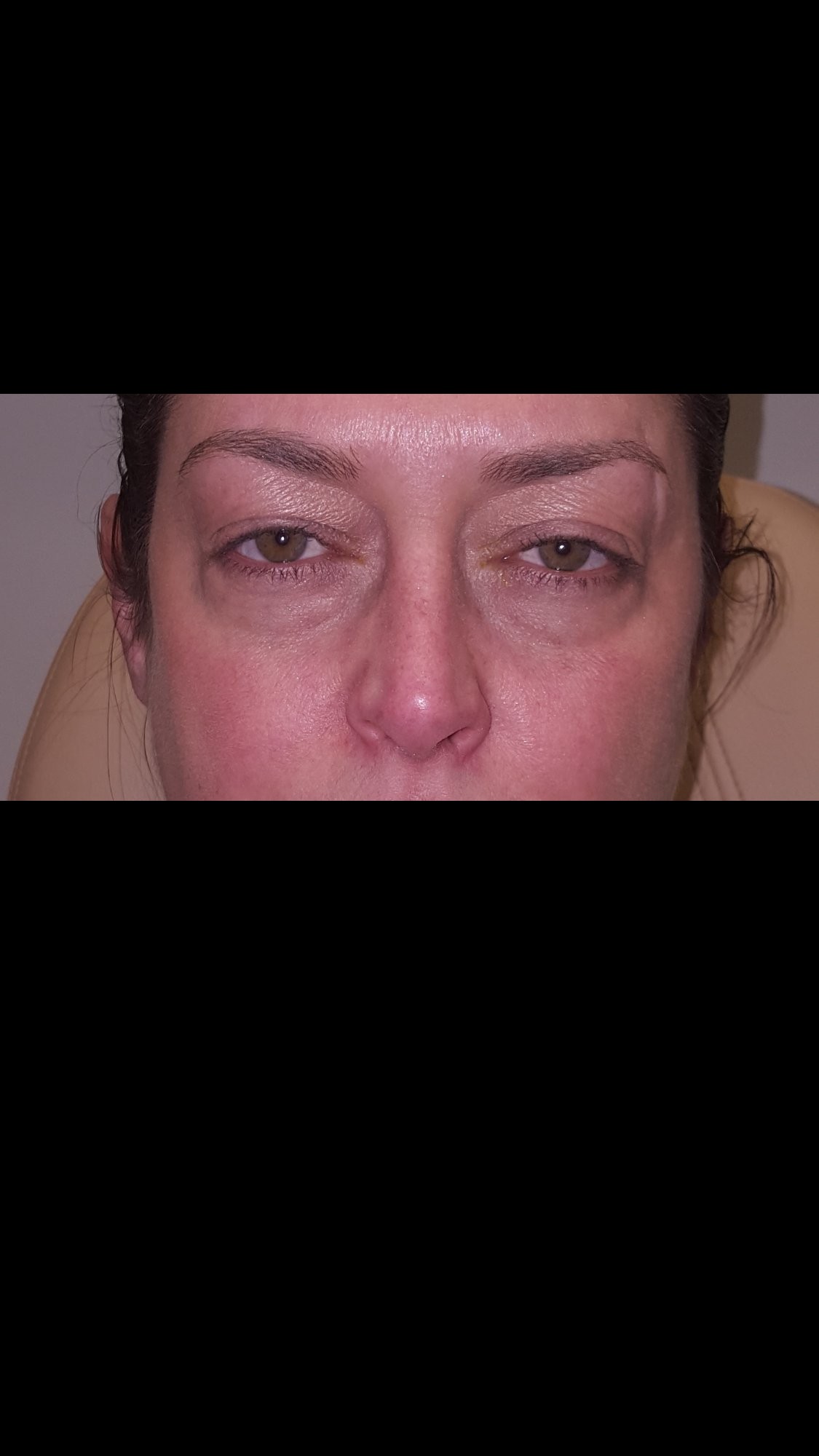 Complete Eyelid Rejuvenation Before