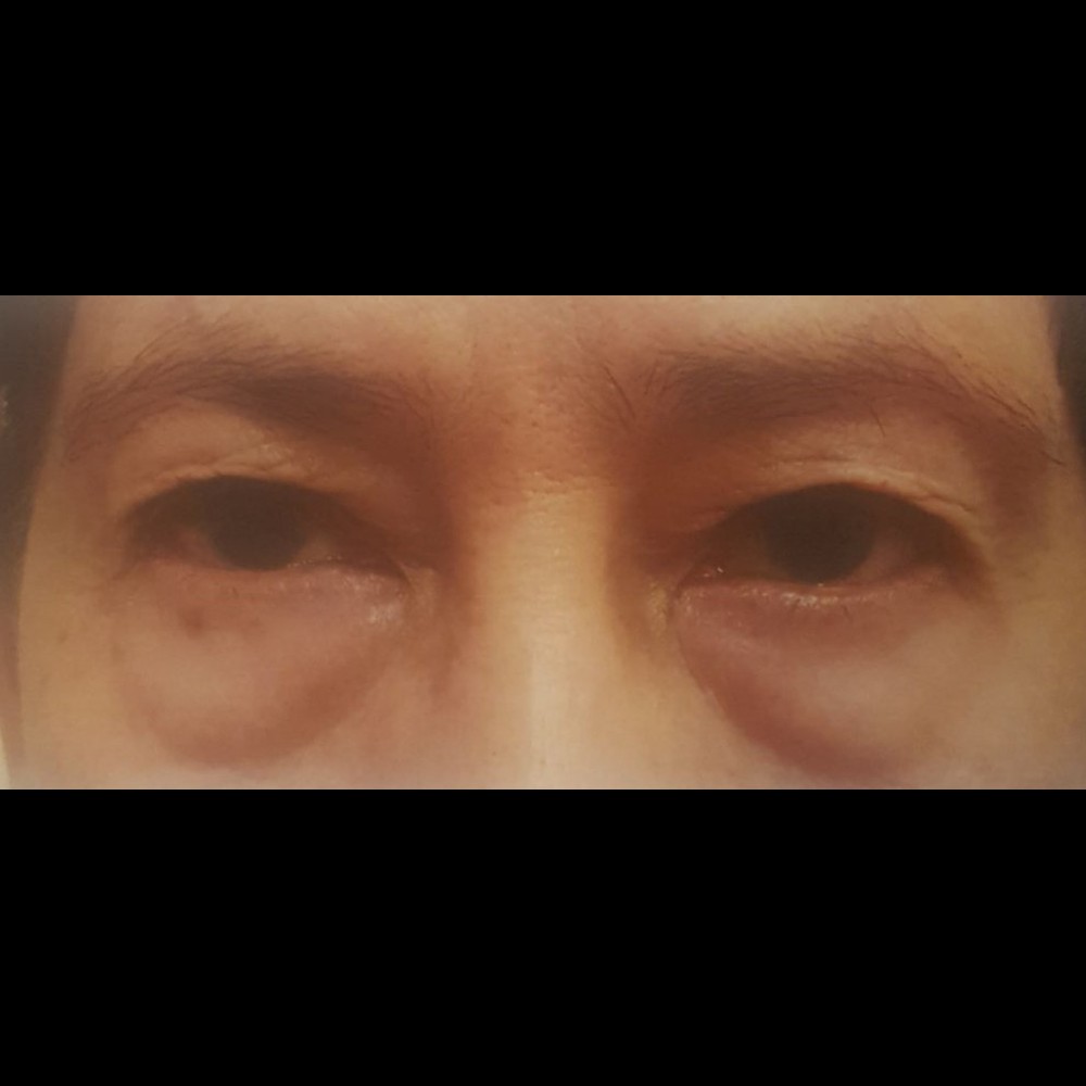 Complete Eyelid Rejuvenation Before