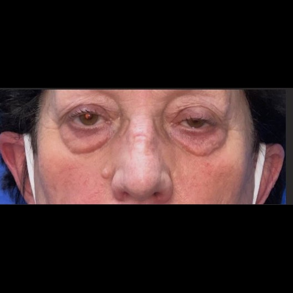 Complete Eyelid Rejuvenation Before