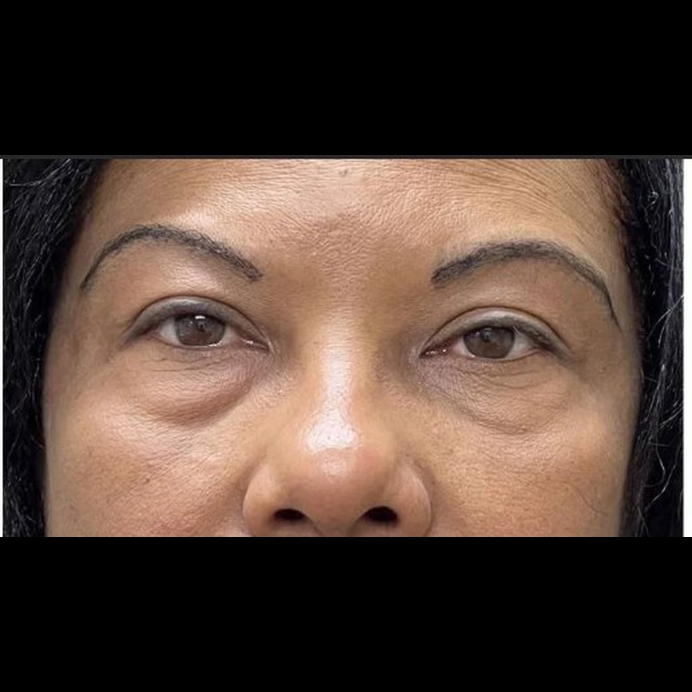 Complete Eyelid Rejuvenation Before