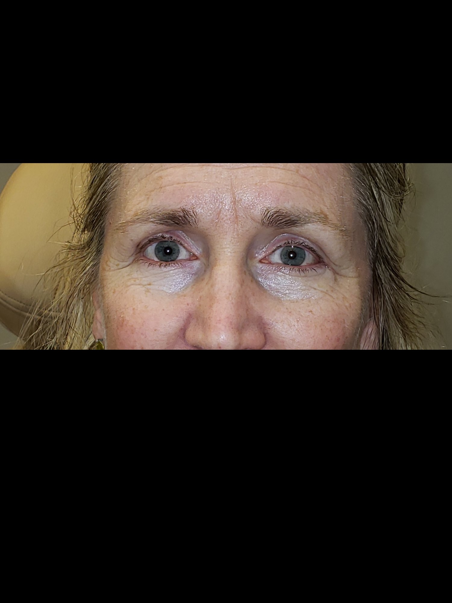 Lower Blepharoplasty After