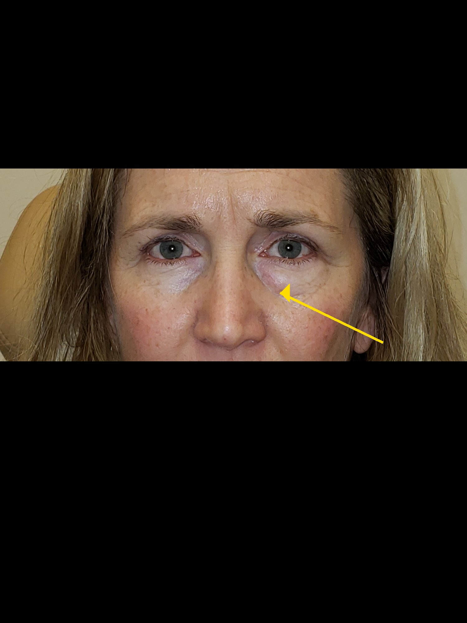 Lower Blepharoplasty Before