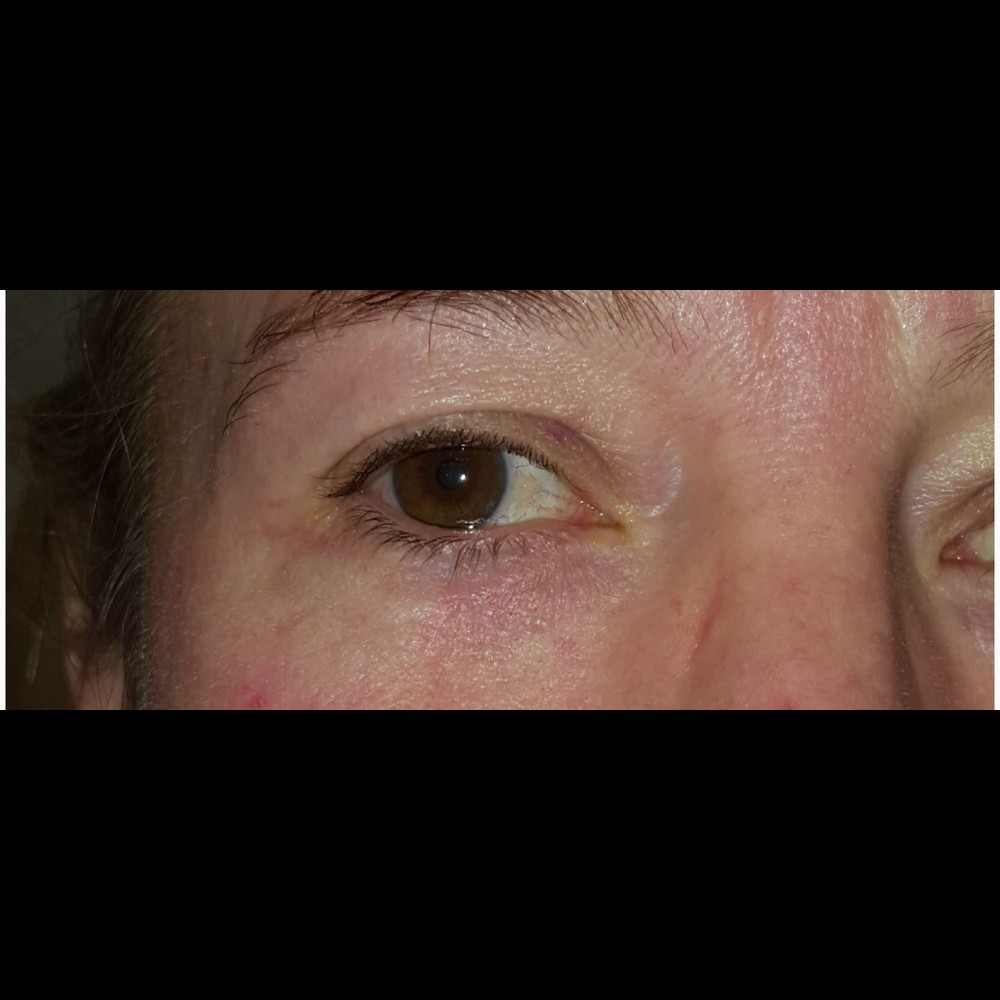 Mohs Reconstruction Result