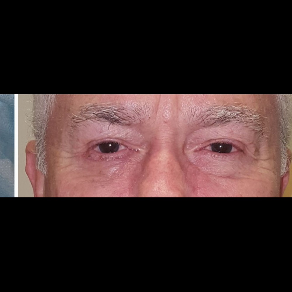 Mohs Reconstruction After