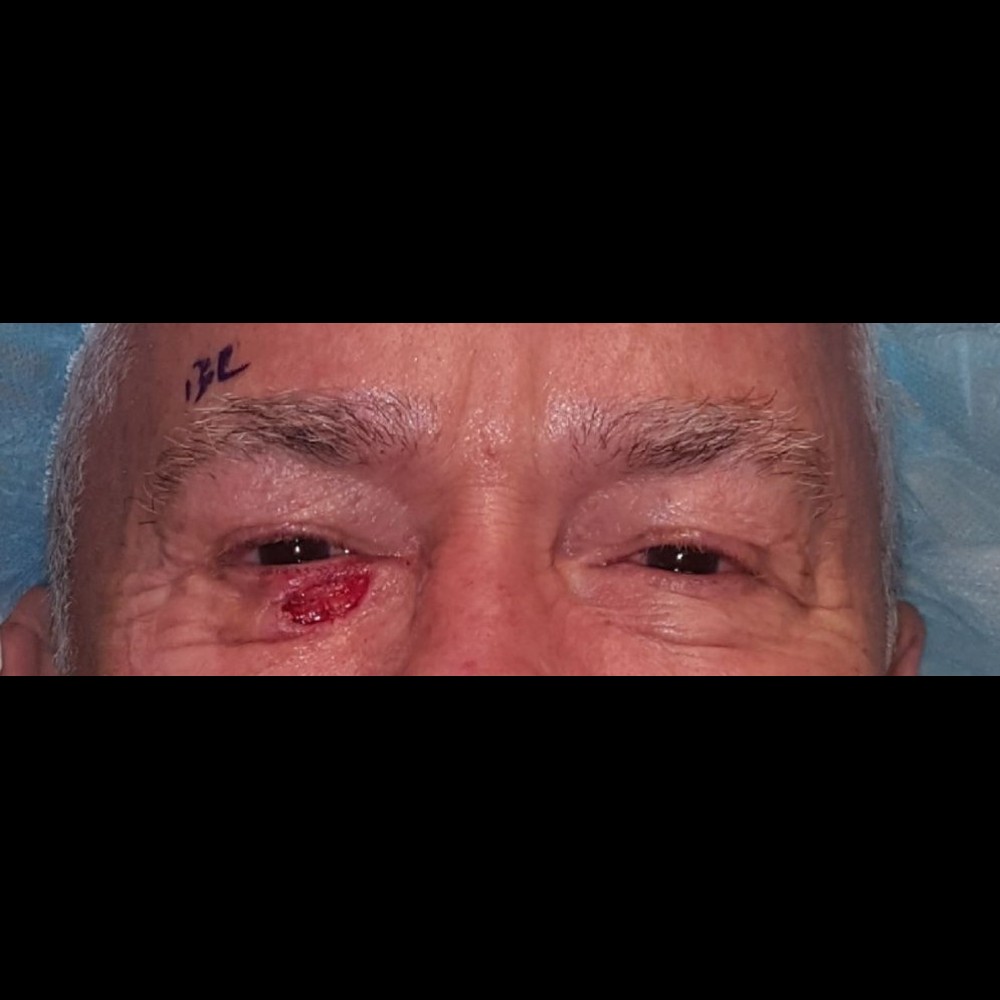 Mohs Reconstruction Before