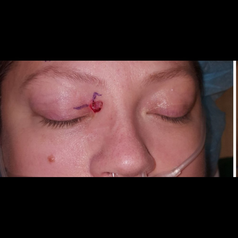 Eyelid Reconstruction Step 1