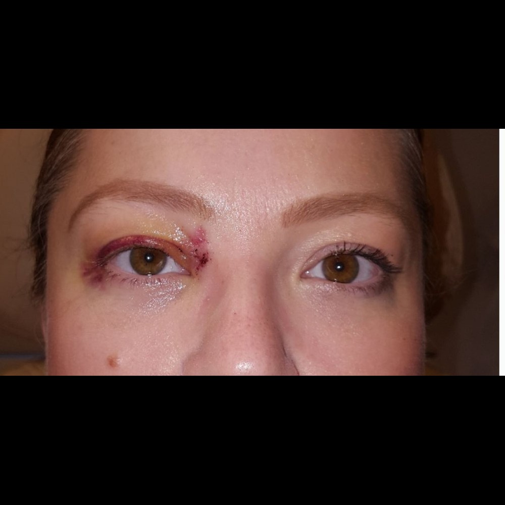 Eyelid Reconstruction Step 2