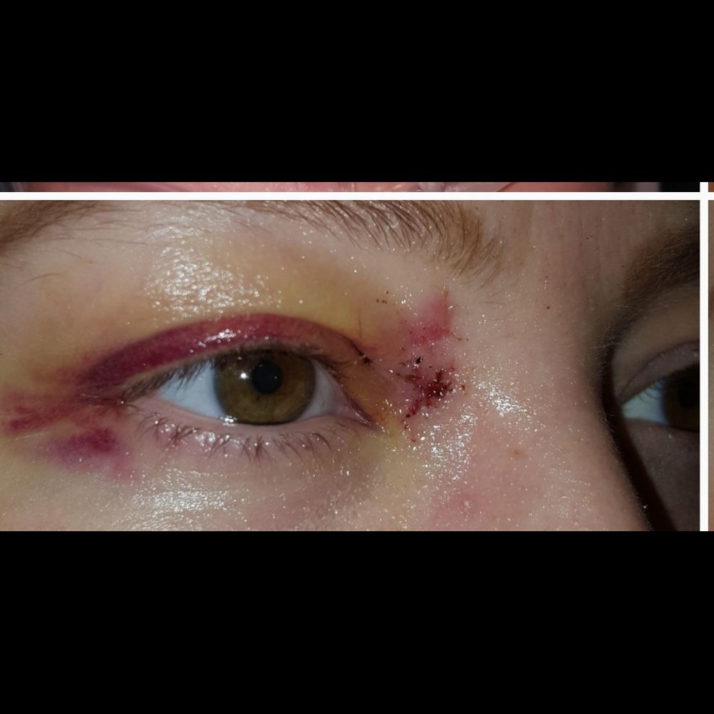 Eyelid Reconstruction Step 3