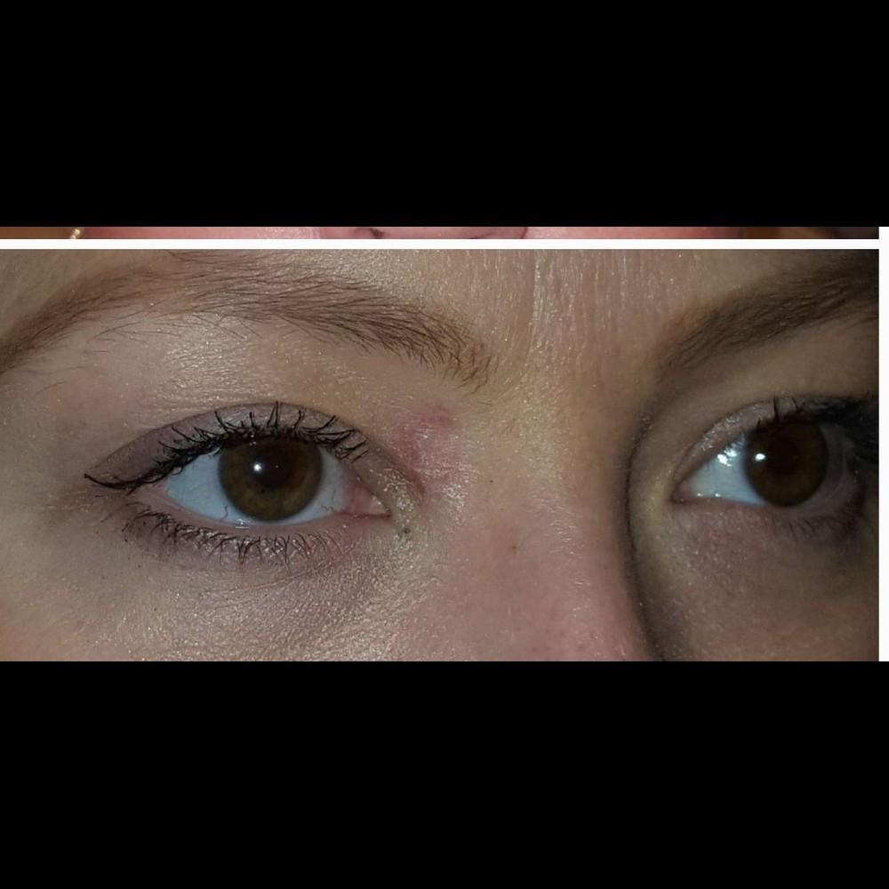 Eyelid Reconstruction Step 4