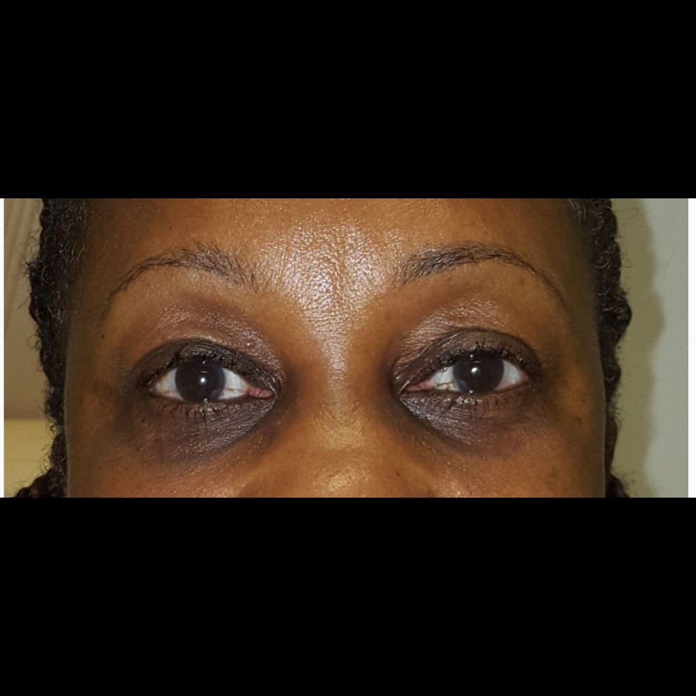 Ptosis Repair After