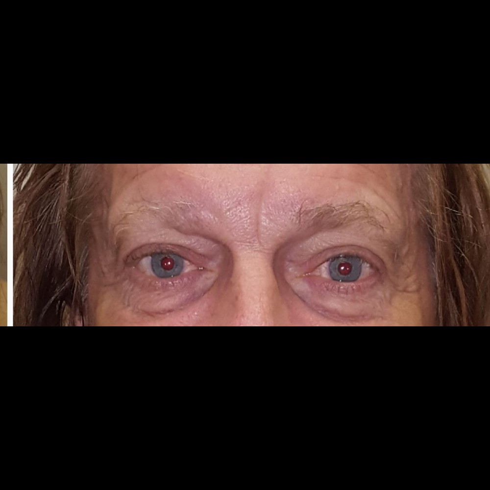Ptosis Repair After