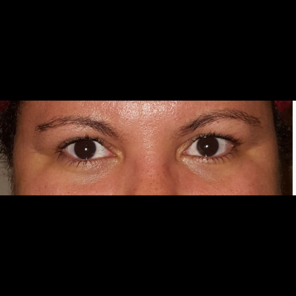 Ptosis Repair After