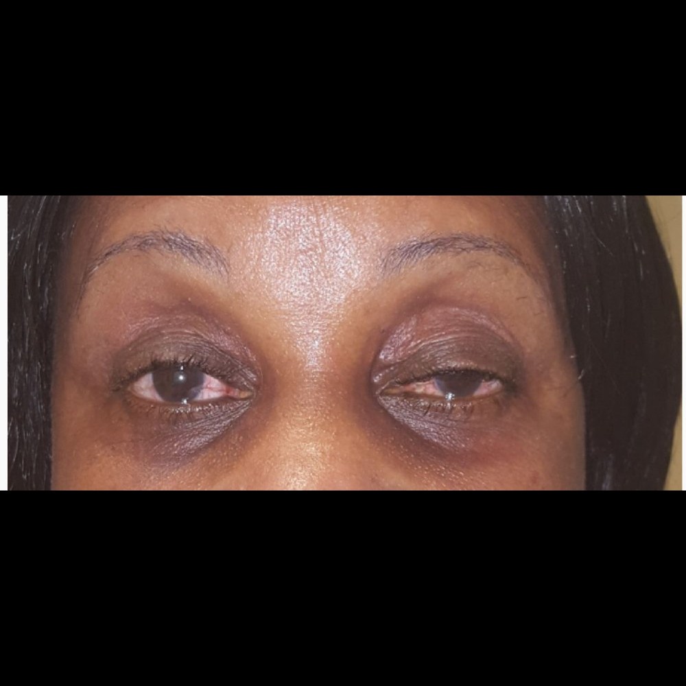 Ptosis Repair Before