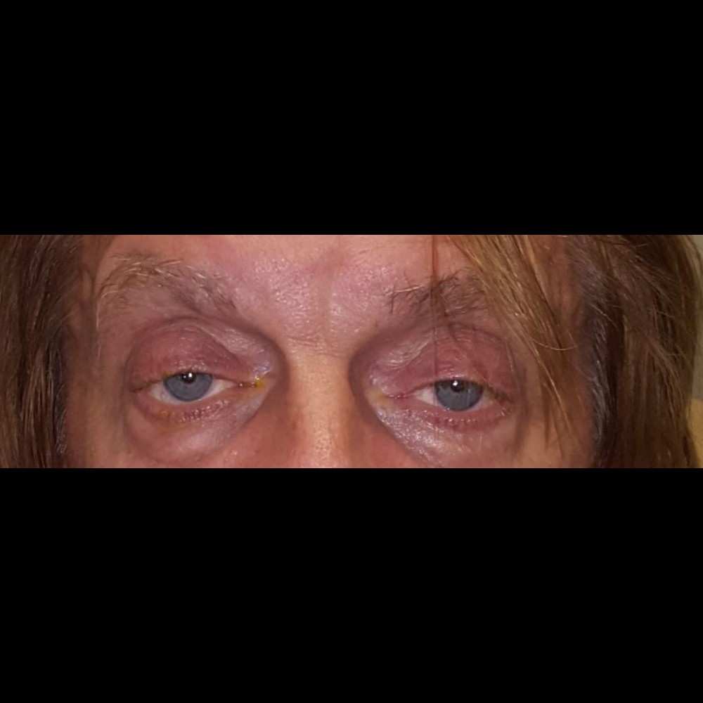 Ptosis Repair Before