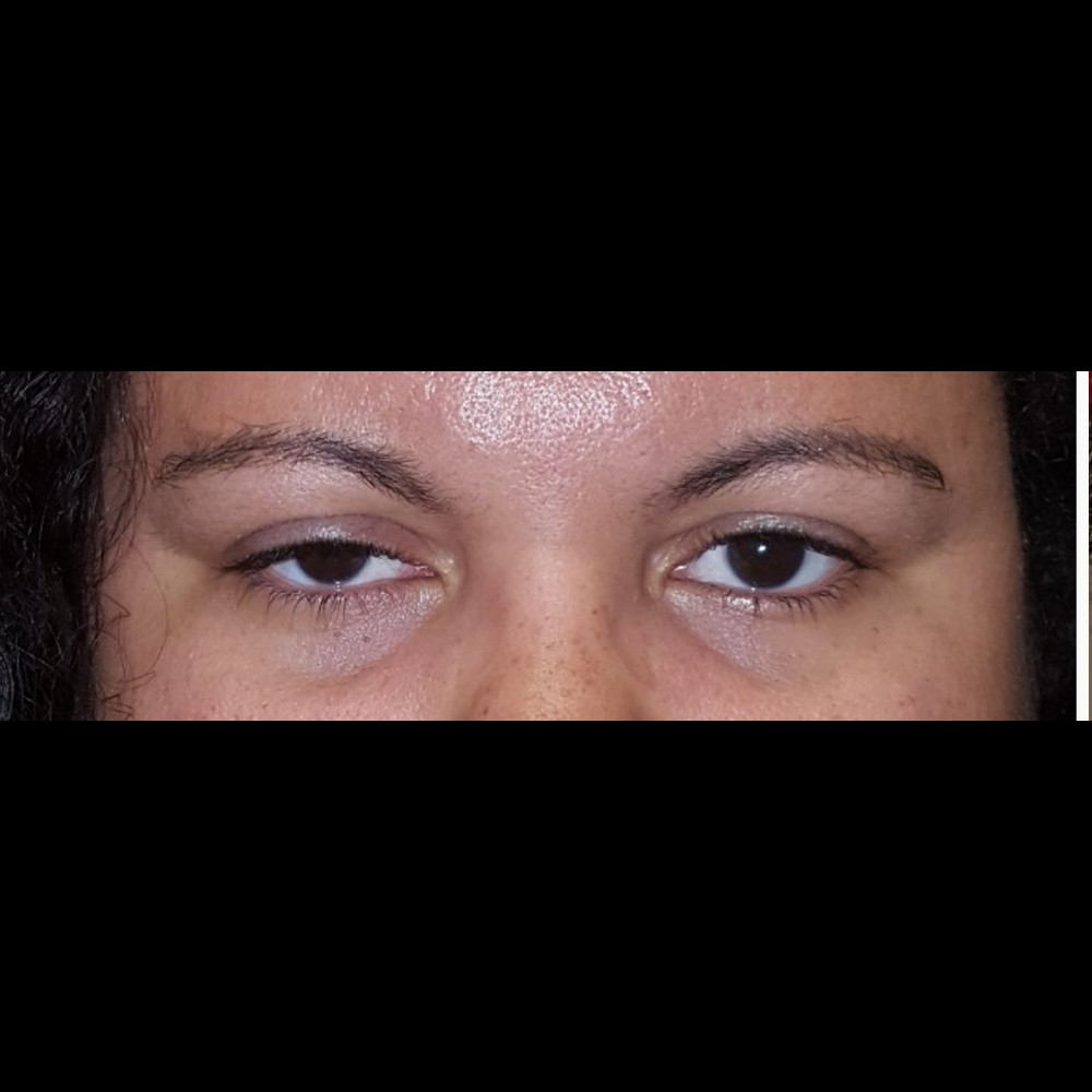 Ptosis Repair Before