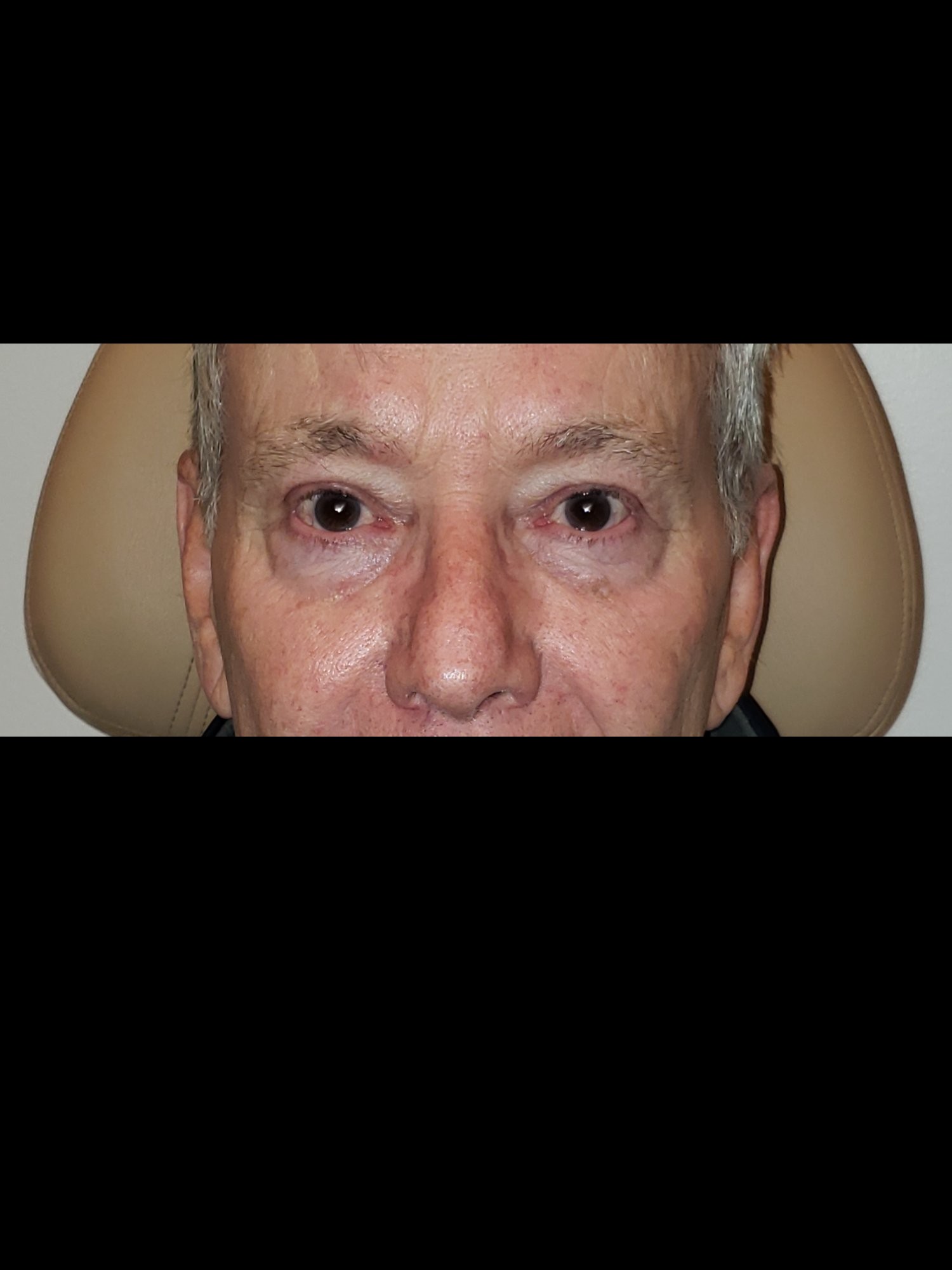 Upper Blepharoplasty After