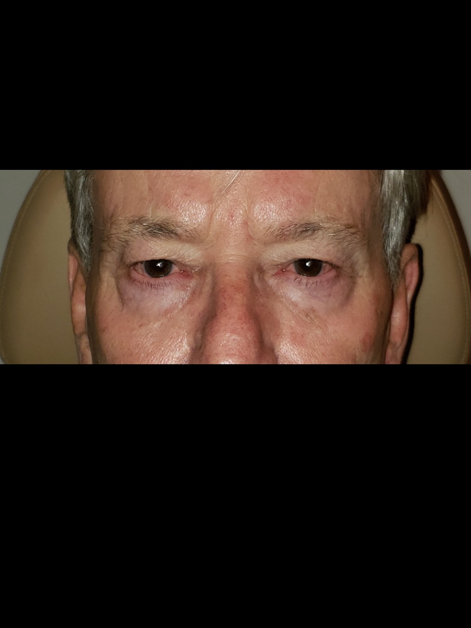 Upper Blepharoplasty Before